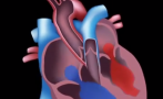 This video provides an overview of how RHD affects the heart and is part 3 of the Introduction to Acute Rheumatic Fever and Rheumatic Heart Disease online learning module. 