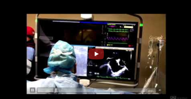 Balloon mitral valvuloplasty – live case
